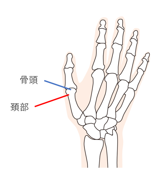 交通事故による中手骨骨折と後遺障害／ハビリス法律事務所（東京都