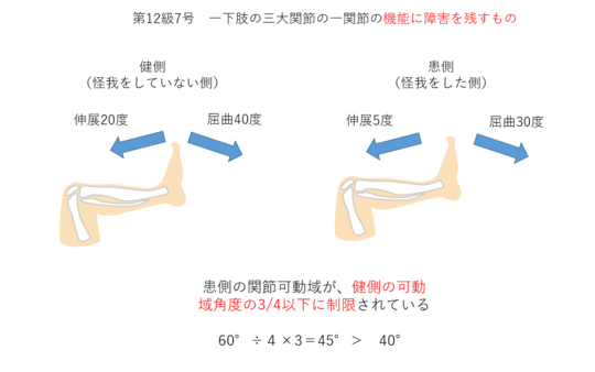 脛骨骨折と後遺障害 東京都で後遺障害 交通事故なら医療資格保有弁護士のハビリス法律事務所へ