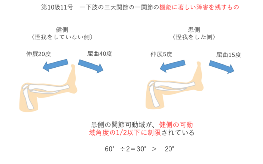 脛骨骨折と後遺障害 東京都で後遺障害 交通事故なら医療資格保有弁護士のハビリス法律事務所へ